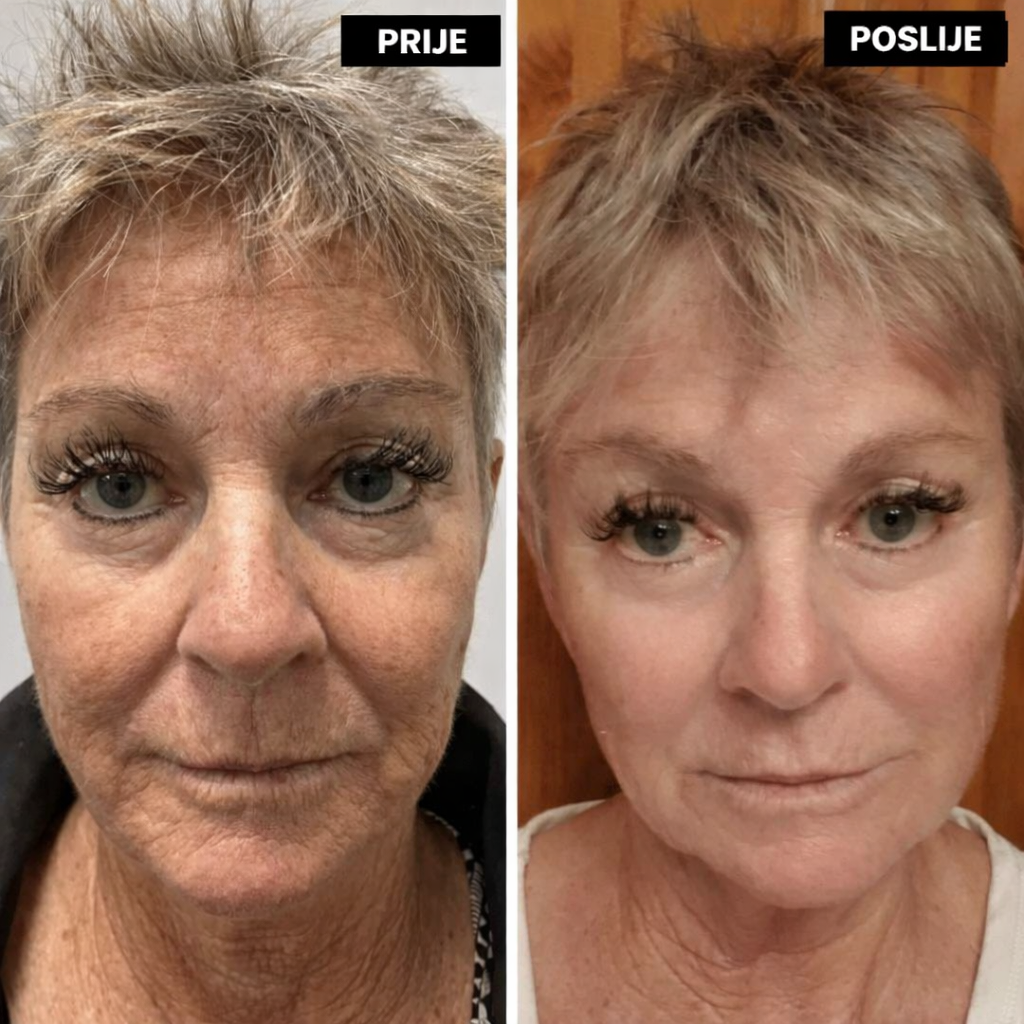 Retivelle™ Alternativa retinolu sljedeće generacije